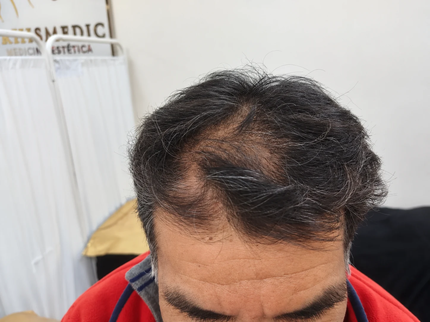 Fotografía antes de la comparación capilar 2